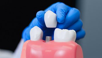 What Are Some Alternatives To Dental Implants?