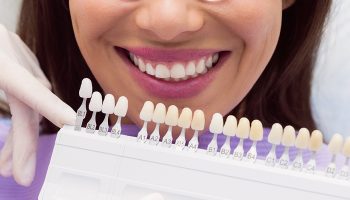 Top Seven Realities to Understand before Getting Dental Veneers