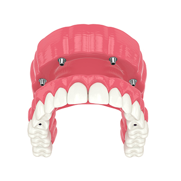 All on 4 Denture Implant Service