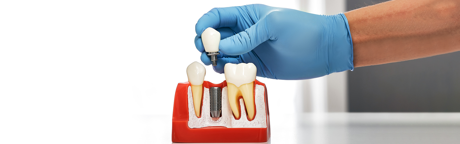 7 Essential Tips for Caring for Your New Dental Implants