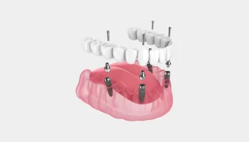 Who Is a Good Candidate for All-on-4® Denture Implants?